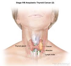 The earliest sign of thyroid cancer is typically a lump or nodule at the base of the neck. Thyroid Cancer Treatment Adult Pdq Treatment Patient Information Nci Michigan Medicine