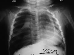 This buildup of air puts pressure on the lung, so it cannot expand A Plain Chest X Ray Film Shows Massive Right Pneumothorax With Download Scientific Diagram