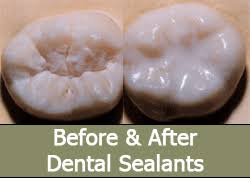 Brushing and flossing are the best ways to help prevent cavities, but it's not always easy to clean every in fact, sealants have been shown to reduce the risk of decay by nearly 80% in molars. Dental Sealants Fissure Sealants In Kingston London Available Everyday
