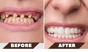 Dental Implant Surgery: What to Expect Before, During, and After