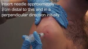 Image result for Subacromial Space Injection