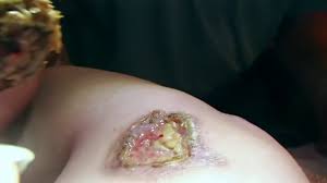 Scabs are not the same as scars. Eschar Vs Scab