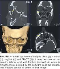 Maybe you would like to learn more about one of these? Scielo Brasil Computed Tomography Imaging Strategies And Perspectives In Orbital Fractures Computed Tomography Imaging Strategies And Perspectives In Orbital Fractures