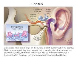 Image result for Tinnitus