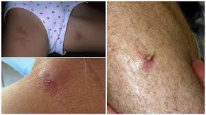 Lors de l'éclosion, la larve de saumon sort d'abord la tète ou la queue. Mouches Larves Dans Le Corps Humain