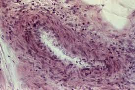 Окраска гематоксилином и эозином (×100). Periarteriit Uzelkovyj Medicinskaya Enciklopediya