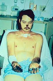 Check spelling or type a new query. Bubonic Plague Wikipedia