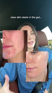 Gut Friendly Meals for Hormonal Balance and Clear Skin