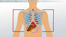Image result for icd 10 code for contusion of right rib