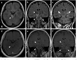 Radiology department of the rijnland hospital, leiderdorp and the onze lieve vrouwe gasthuis, amsterdam, the netherlands. Figure 1 From Chronic Lymphocytic Inflammation With Pontine Perivascular Enhancement Responsive To Steroids Clippers With Limbic Encephalitis Semantic Scholar