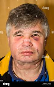 Head trauma hi-res stock photography and images