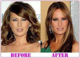 Melania trump has gone an incredible way to fame and rose to unattainable heights. Nicki Minajoe Melania Trump Plastic Surgery Before Amp After Celebrity Plastic Surgery Cosmetic Surgery Plastic Surgery