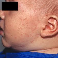 Image result for yellow scabs on the face in children