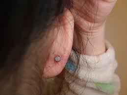 Accidentally Snagged My 2 Month Old Piercing Resulted In Clear White Pus Bleeding I Ve Used Saline Spray For Now Which Might Be Why My Ear Looks So Dry But Should I Soak