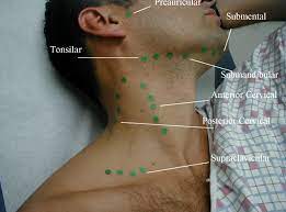 Cancerous lymph nodes may feel rubbery and clumped together in the case of lymphomas or hard and immobile in the case of metastatic cancers, according to the merck manual home edition. Uc San Diego S Practical Guide To Clinical Medicine