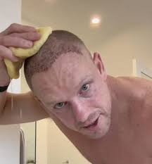 Ontario dad documents his hair transplant journey