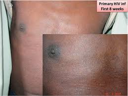 Image result for skin rash acute hiv infection