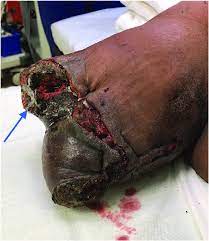 If a burn scab (eschar) goes completely around a limb, it can tighten and cut off the blood circulation. Right Upper Extremity Stump Site With Wound Dehiscence Necrosis And Download Scientific Diagram