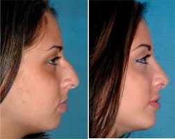 Pin On Nose Job Rhinoplasty Nose Job Cost Celebs Nose Job