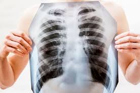 Jangan ragu untuk segera ke. Gejala Penyakit Paru Harus Diwaspadai Ini 5 Tandanya Harus Ke Dokter Semua Halaman Grid Health
