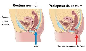 Vous faites un crise d'hémorroïdes ? Prolapsus Rectal Rectocele Causes Traitement Operation