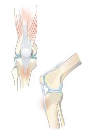 Morbus Osgood Schlatter Knie Verletzungen Push Braces