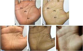 A simian line is also called the simian crease, simian fold, palmar crease, transverse palmar crease, and single transverse palmar crease. as many as one in 30 people have this marking on their hands, which has been linked with down syndrome, turner syndrome, trisomy 13, and several other health conditions. Prevalence Of The Different Types Of Palmar Creases Among Medical And Dental Students In Addis Ababa Ethiopia Abstract Europe Pmc