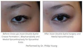 Before After Close Ups Asian Double Eyelid Crease Formation Blepharoplasty And Medial Epicanthoplasty F Asian Plastic Surgery Double Eyelid Plastic Surgery