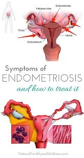 What Is Endometriosis Endometriosis Symptoms Endometriosis Endometriosis Diet
