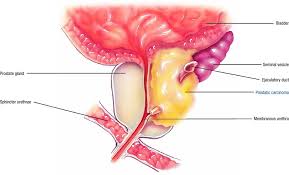 15.08.2021 · when advanced prostate cancer causes bilateral hydronephrosis. Prostate Cancer Atlas Of Pathophysiology 2 Edition