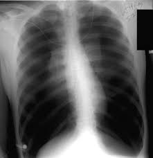 Image result for Open Pneumothorax