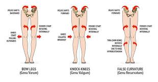 False Curvature Of The Knees Bow Legged Correction Bow Legged Knock Knees