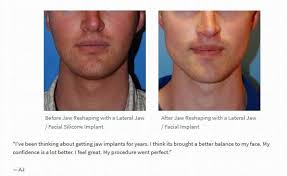 Feel More Confident About Yourself Jaw Implants Can Markedly Enhance Your Look Read This Jaw Implant Review Silicone Implants Plastic Surgery Cosmetic Treatments