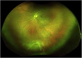 Jan 23, 2018 · rhegmatogenous retinal detachment is a break, tear, or hole in the retina. Retinal Tear And Posterior Vitreous Detachment Following Repetitive Transcranial Magnetic Stimulation For Major Depression A Case Report Brain Stimulation Basic Translational And Clinical Research In Neuromodulation