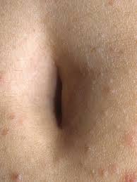 Der Bauchnabel Vergleich Navel Bellybutton Nombril Innie Outie Flatie Posts Facebook