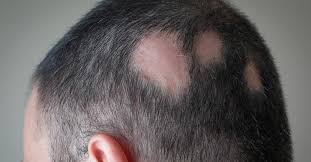 However, additional side effects may be associated with the medication not reported in the monograph. Autoimmune Disease And Hair Loss Rhrli