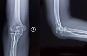 'the olecranon is the bony landmark identified as the elbow in surface anatomy.' 'patients with longstanding gout may have tophi over the olecranon prominence, first metatarsal joints, or pinnae.' Olecranon Fracture