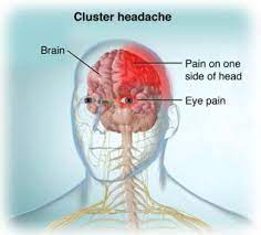 Cluster Headache Natural Remedies Ayurveda Cluster Headaches Headache Treatment Natural Headache Remedies