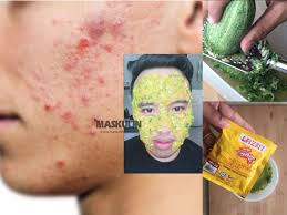 Bekas jerawat, baik yang berwarna merah maupun hitam, adalah kondisi kulit yang cukup berbeda dengan jaringan parut, noda hitam atau merah akibat jerawat yang parah ini bisa diobati, baik dari. Kesan Parut Hitam Hilang Hanya Guna Timun Dan Serbuk Kunyit Maskulin