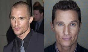 If You Want To Get Hair Transplant And Wondering About The Cost Then Don T Because At Satyam Hair Transplant Australia Its Pocke Masculino Moda Masculina Moda