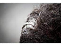 Born literally in her mom's image, this cute little girl has the same white patch of hair her mother has. Poliosis White Hair Patch Symptoms Causes And Treatment Boldsky Com