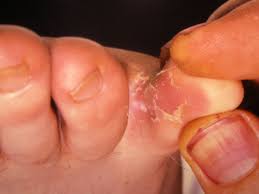There are some conditions that may call for medical attention while others may just go away on their own after the underlying condition has been solved. Common Foot Rashes Symptoms Causes And Treatments