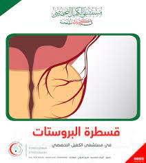 بالقسطار ودون تداخل جراحي.. معالجة سبعيني يعاني من تضخم البروستات الحميد