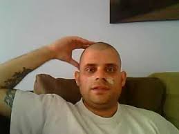 Nasal polyps should be diagnosed by a doctor and can be treated through medication and/or surgery. 24 Hours After Nasal Polyp Surgery Youtube