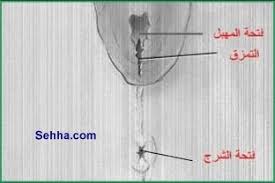 تمزق المهبل والجراحة بعد الولادة بالصور وعندي اسشارة عالم حواء