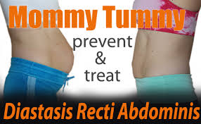 Jul 08, 2021 · how can you treat diastasis recti? Mommy Tummy Evidence Based Techniques For Treatment And Prevention Of Diastasis Recti Pilates Bridge