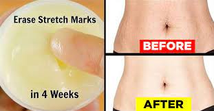 How To Remove Stretch Marks 29 Effective Home Remedies