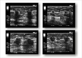 Thus, a major contraindication is inadequate operator experience. Breast Cancer On Ultrasound Imaging Doccheck