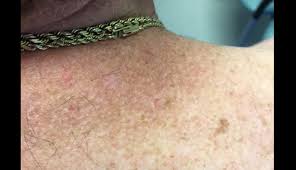 Image result for Solar Lentigo