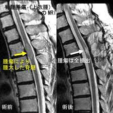 脊髄腫瘍（脊髄髄内腫瘍、脊髄髄外腫瘍、馬尾腫瘍） 脊髄空洞症 syringomyelia 疾患概念 脊髄実質内に髄液の貯留が起こり、拡大伸展すると種々の脊髄症状を生じる。なぜ脊髄内に髄液の侵入が起こり、拡大していくかについては未だ明らかでない。 æ±äº¬å¤§å­¦åŒ»å­¦éƒ¨è„³ç¥žçµŒå¤–ç§' è„Šæ¤Ž è„Šé«„ç–¾æ‚£